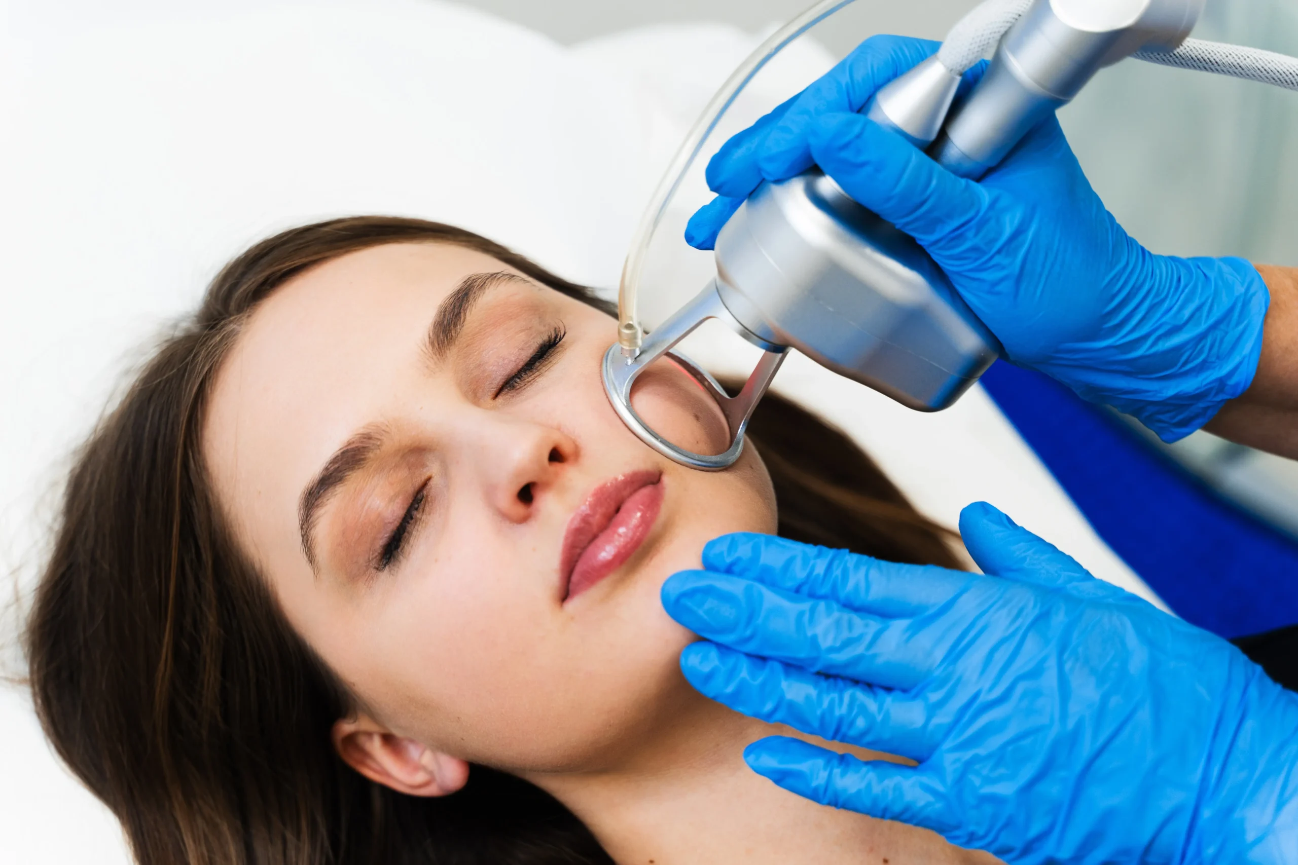 CO2 Laser CoolPeel in Taylorsville, UT at Gemini Glow Medspa