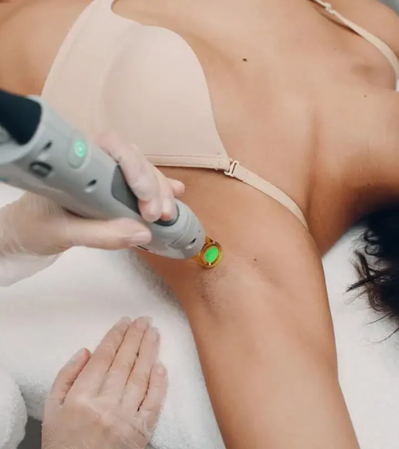 Laser hair removal treatment on underarm area at Gemini Glow Medspa in Taylorsville, UT.